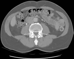 Kidney Stone R Kidney Stone R