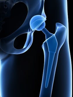 Hip Implant S Hip Implant S