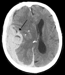 Intracranial Bleed With Significant Midline Shift 5de5d78398407