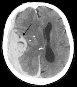 Intracranial Bleed With Significant Midline Shift 5de5d78398407 Intracranial Bleed With Significant Midline Shift 5de5d78398407
